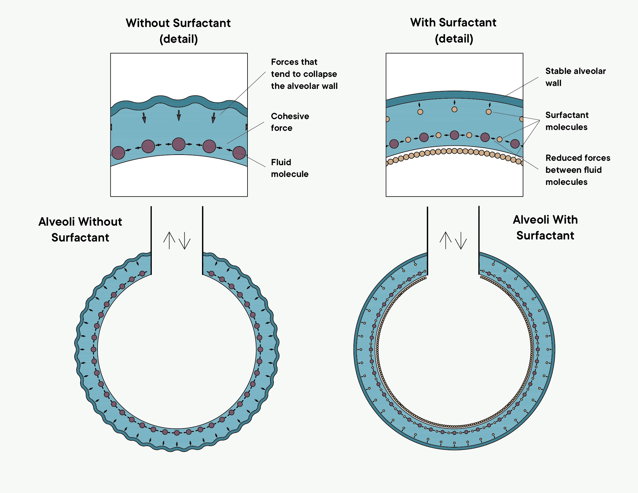 Diagram comparing alveolar wall collapse without surfactant and stabilisation with surfactant molecules.