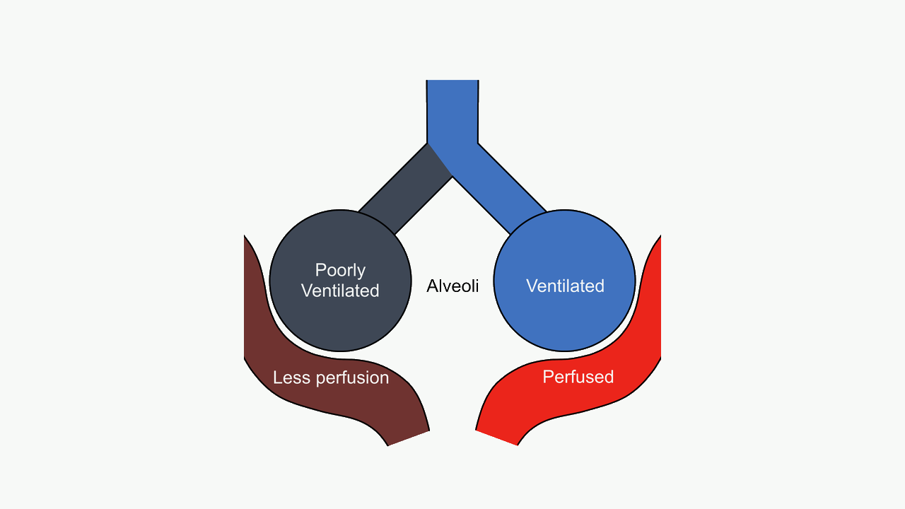 Pulmonary shunt diagram showing perfused alveoli with absent ventilation.